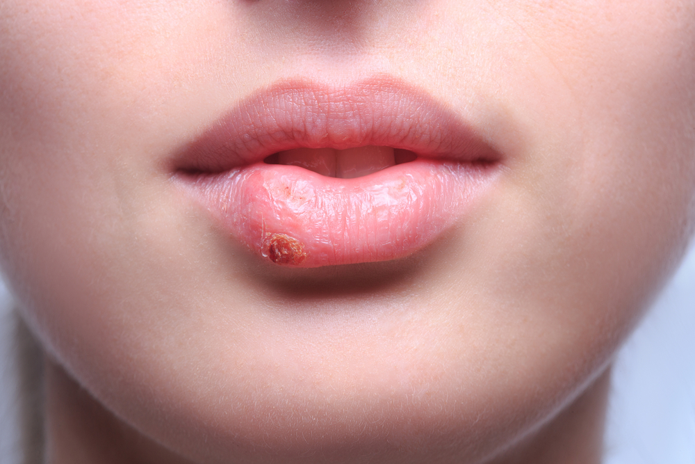 Chlamydia in the Mouth: Yes, It’s Real, Here’s What It Feels Like