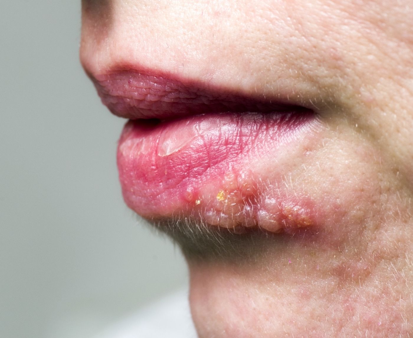 Syphilis vs Herpes: How to Tell Them Apart Without Guessing