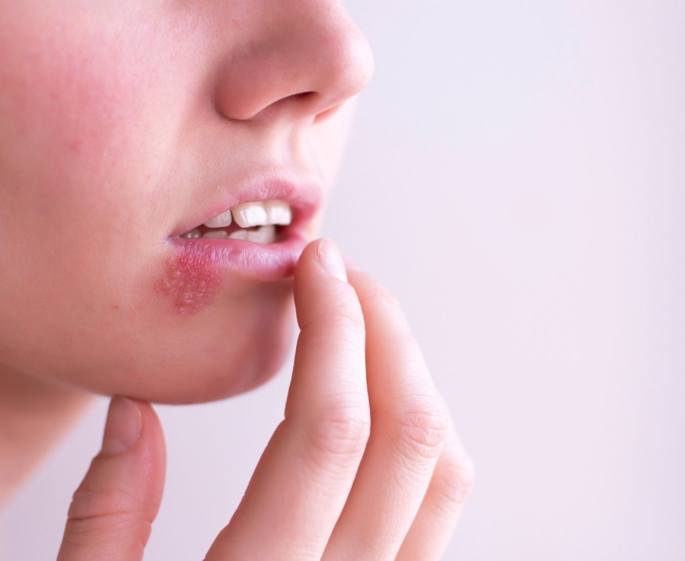 It Came Back… Or Did It? Herpes Reactivation vs Reinfection