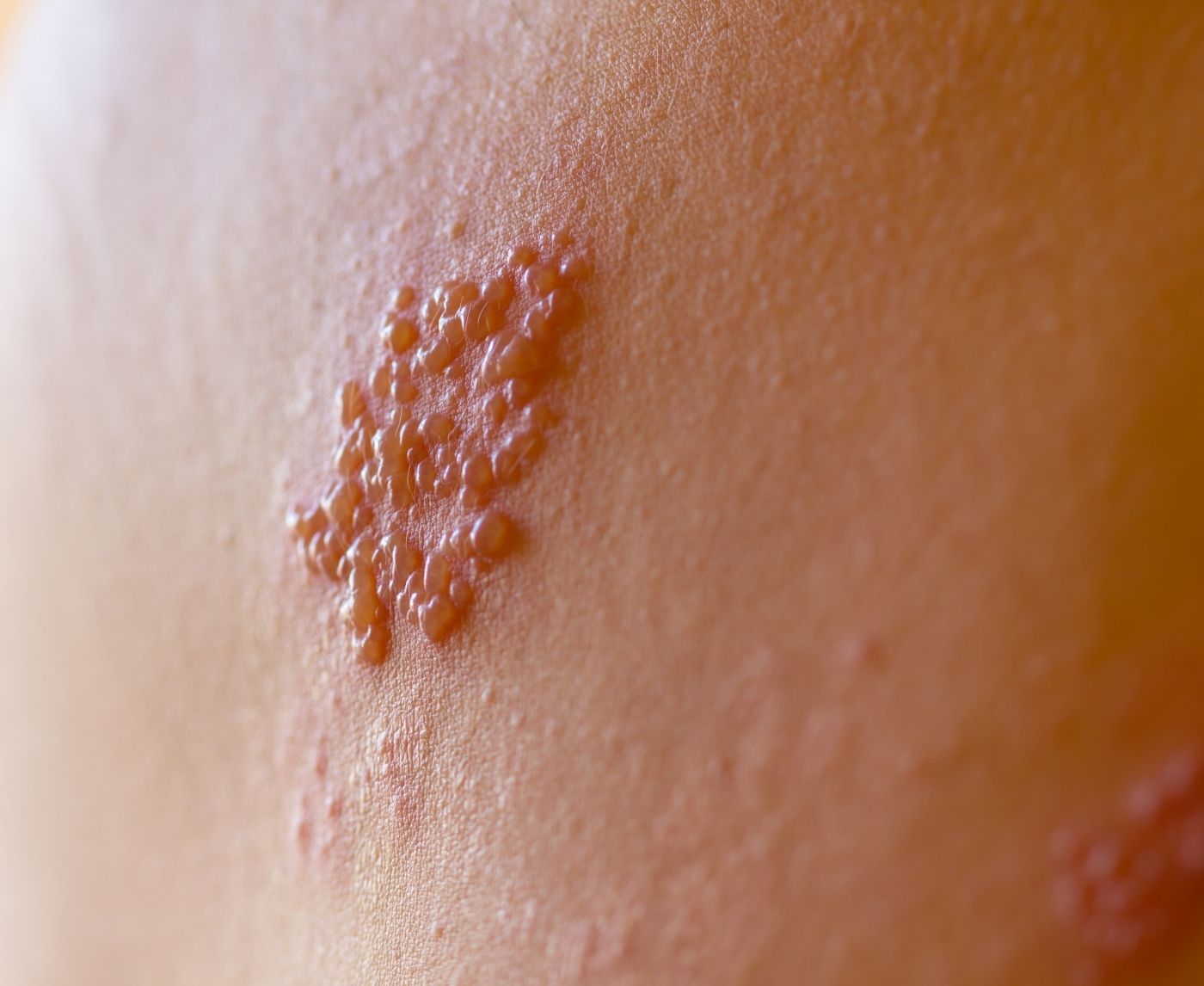 Not All Bumps Are Herpes, But Some Are