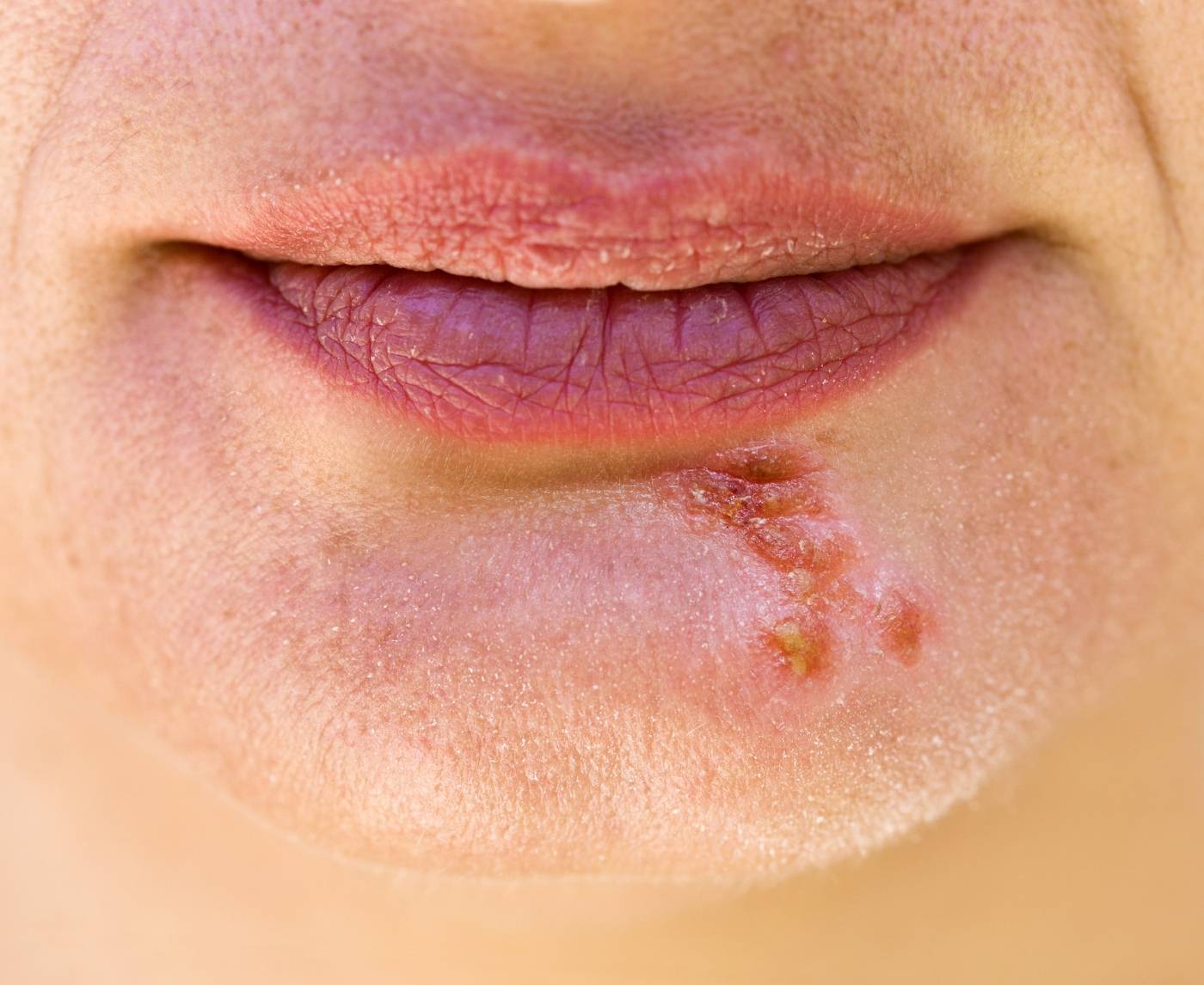 I Keep Getting Sick, Could It Be an Undiagnosed STD?