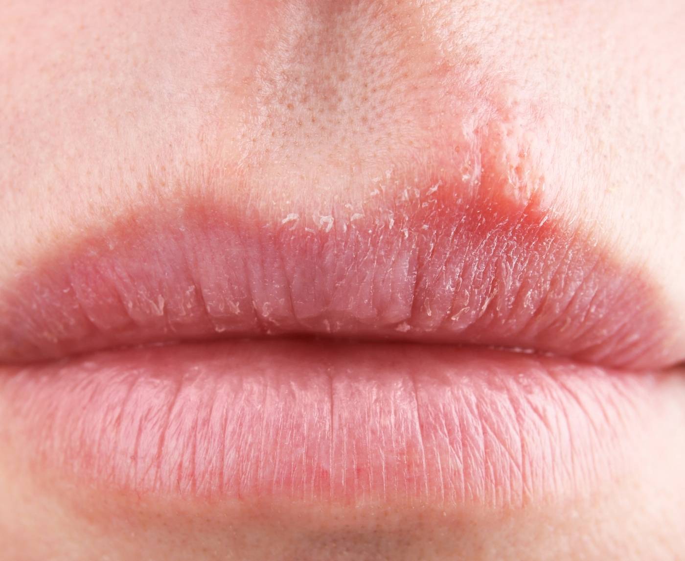 Oral Herpes Doesn’t Always Look Like You Think, Here’s My Story
