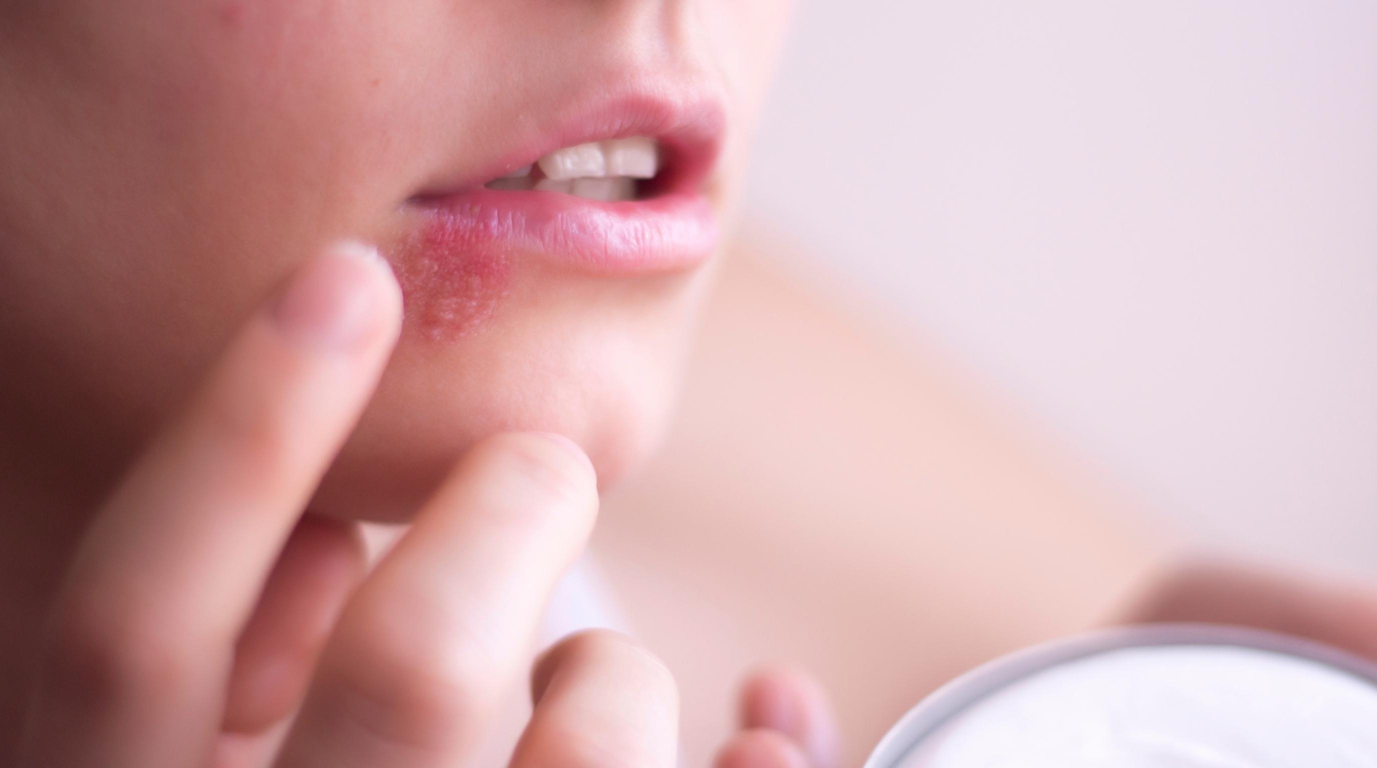 First Signs of Herpes, What You’ll Notice Early and What to Do Next