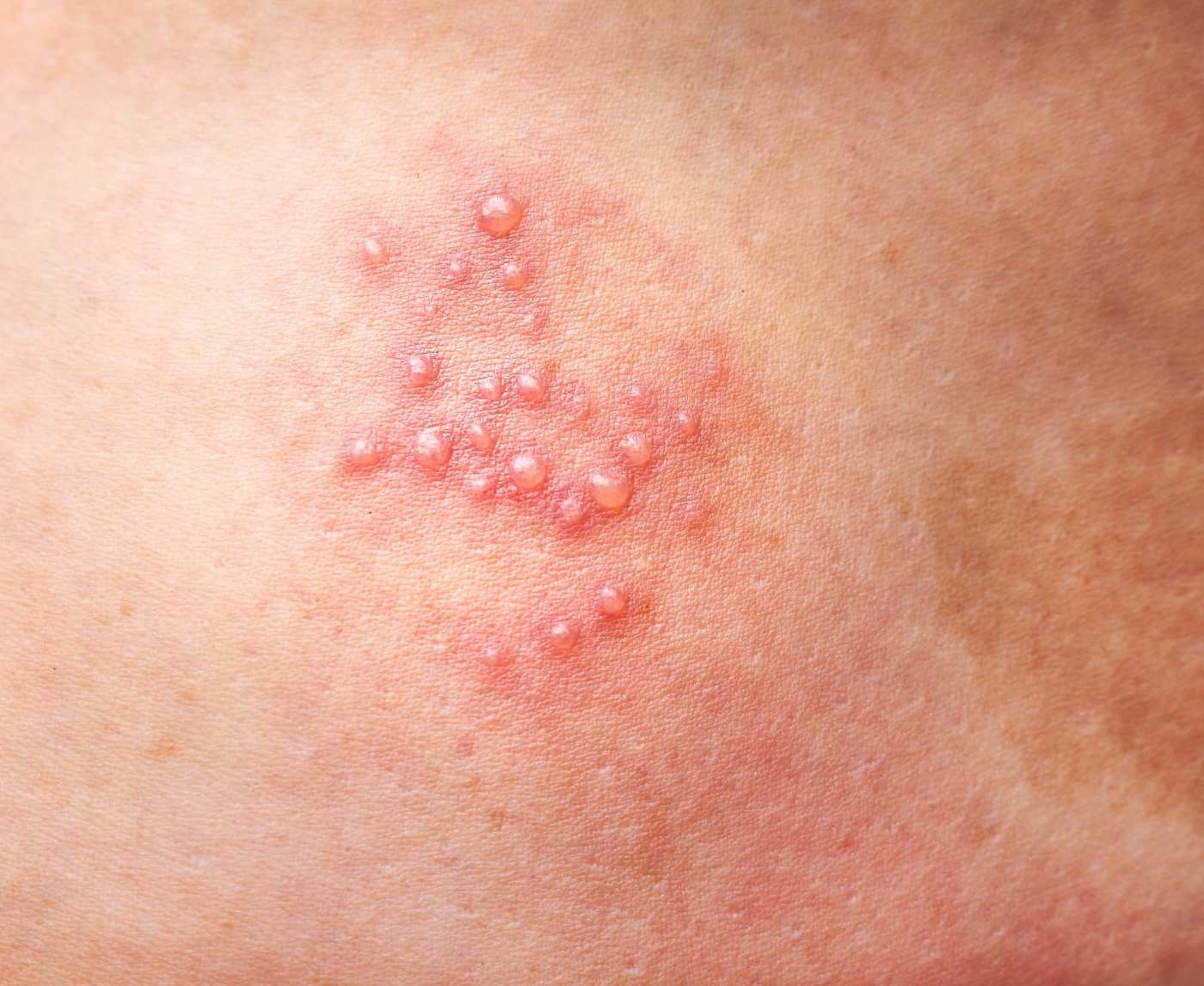 Red Bumps Down There: Herpes or Shaving Issue?