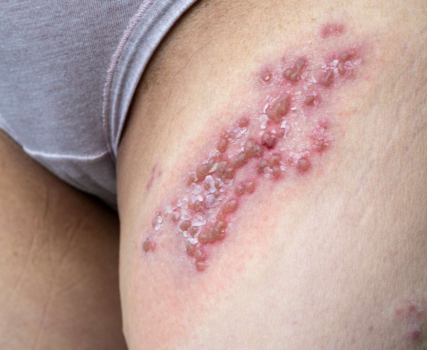 Can Cold Sores Really Give You Herpes Down There?