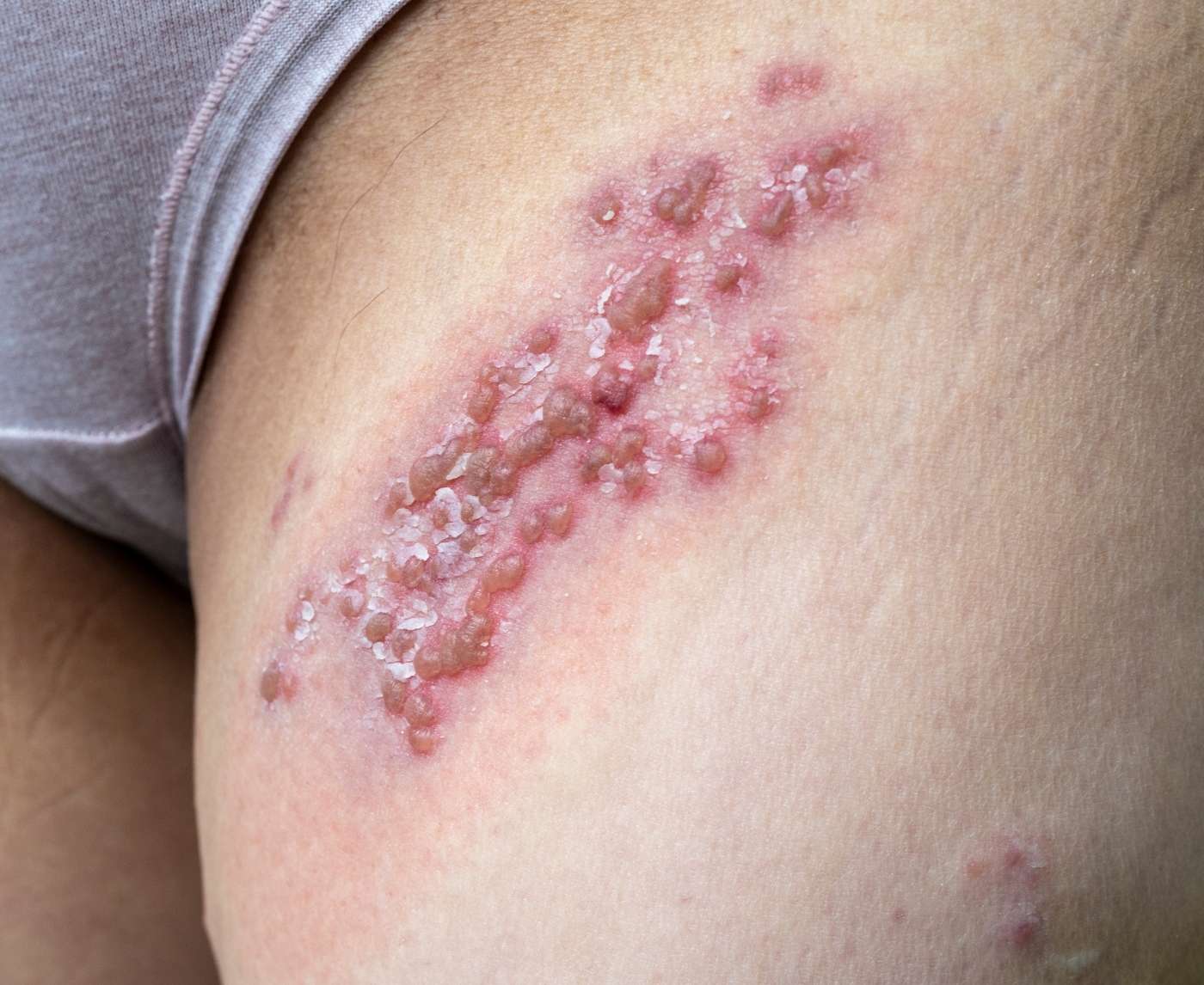 Effective Treatments for Herpes Outbreaks: What You Need to Know