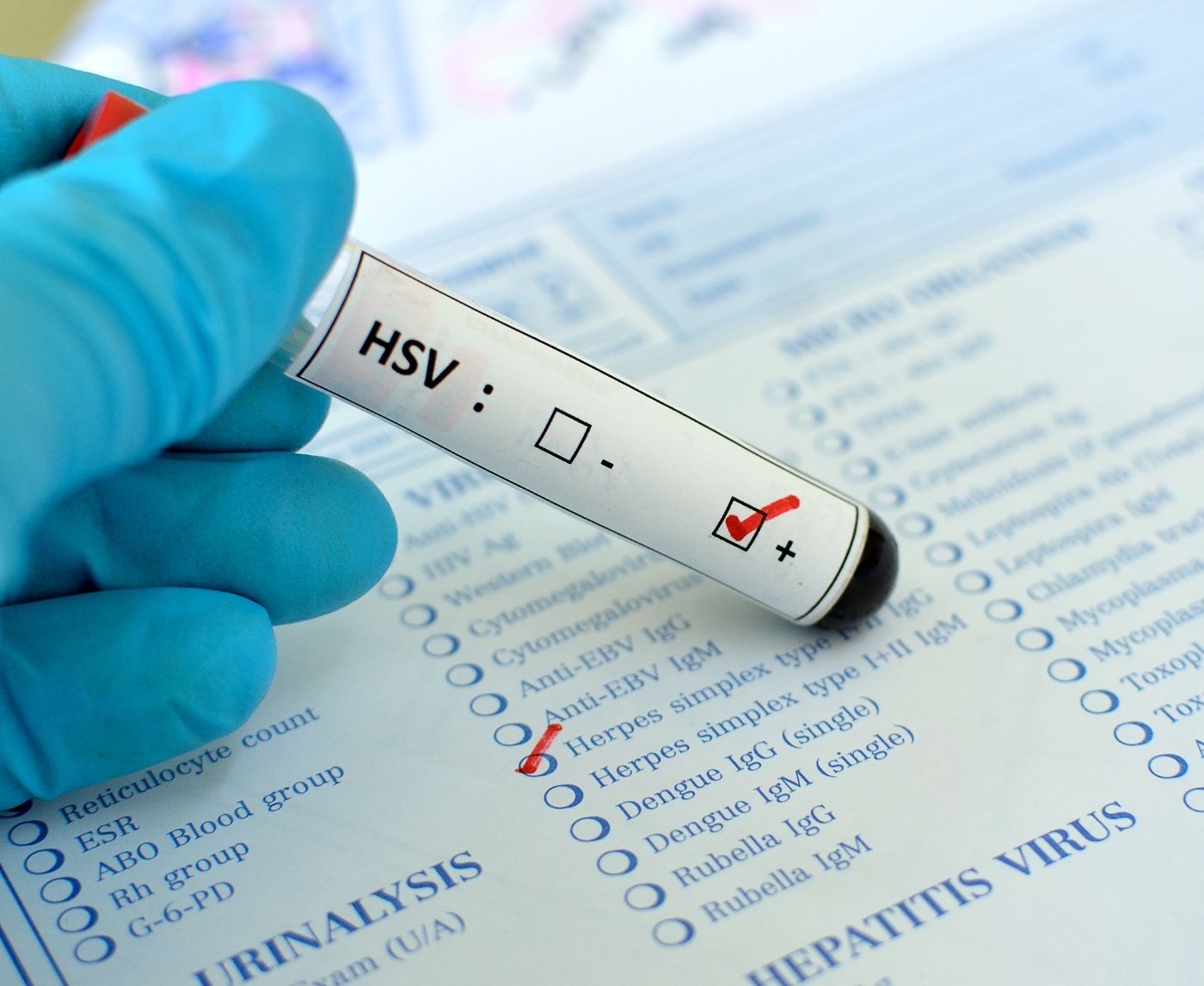 Tested Positive for Herpes? Here’s Exactly What to Do Next