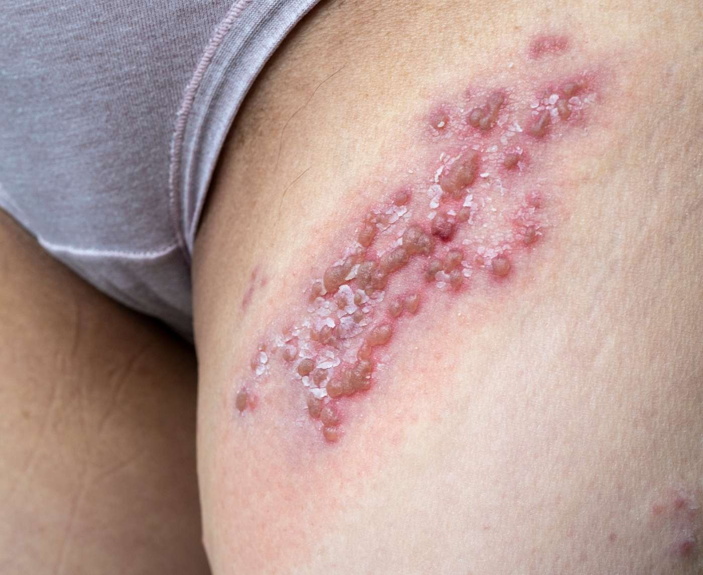 Ignoring Herpes Can Raise Your HIV Risk, Here’s Why That Matters