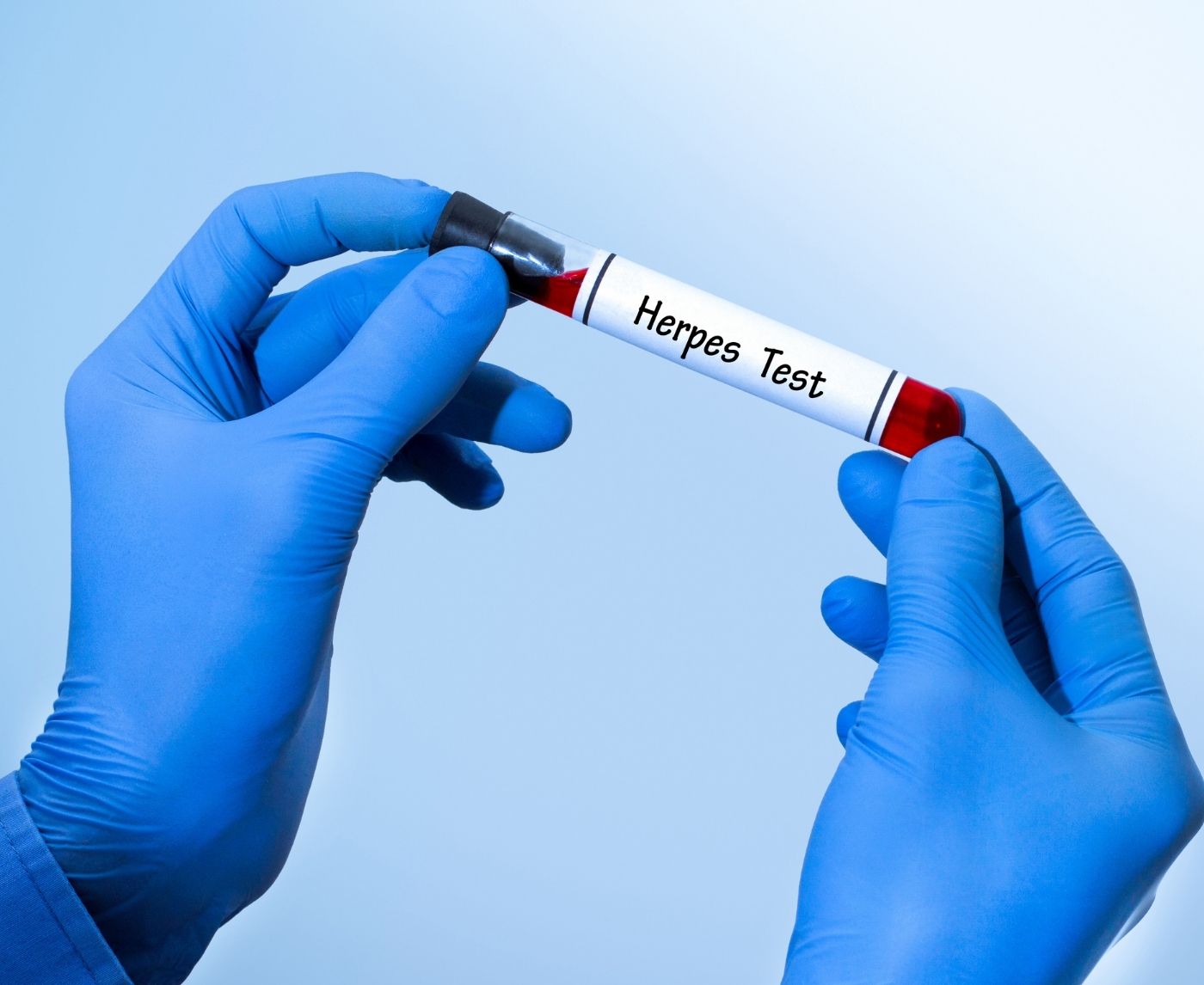 Herpes Testing at Home: Accuracy, Benefits, and Limitations