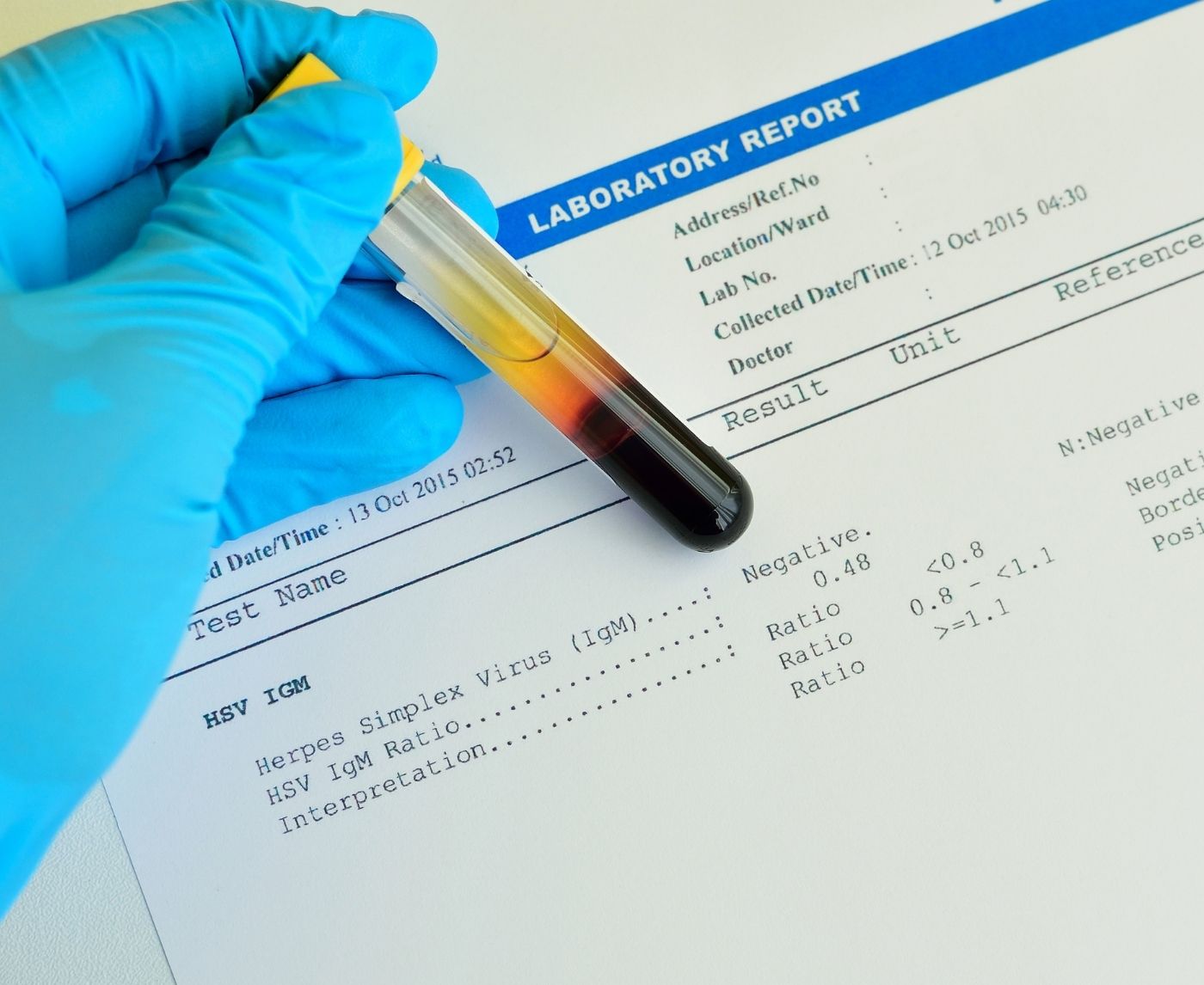 How Soon After Sex Can You Test for Herpes? (Timing by Type)