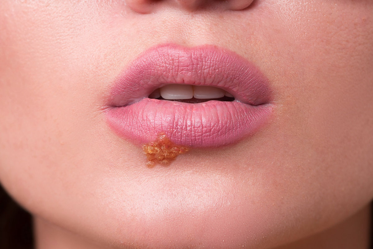 All the Ways Herpes Moves Around