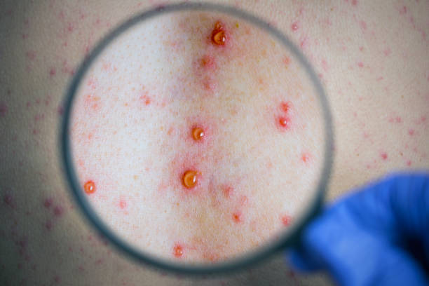 Is That Syphilis or Just a Skin Thing? Here’s How It Starts
