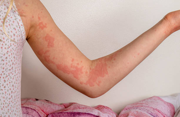 The Rash That Won’t Quit: When It’s Not Just an Allergy