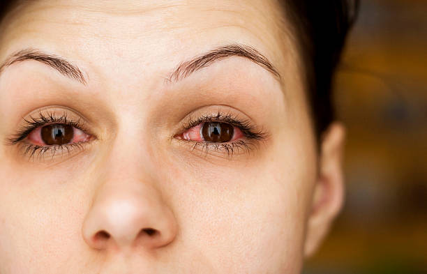 STD in My Eye? The Truth About Herpes, Pink Eye, and That Weird Burning