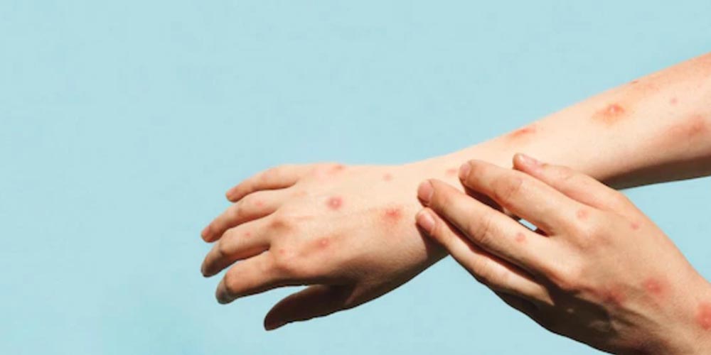 Monkeypox or STD Symptoms?