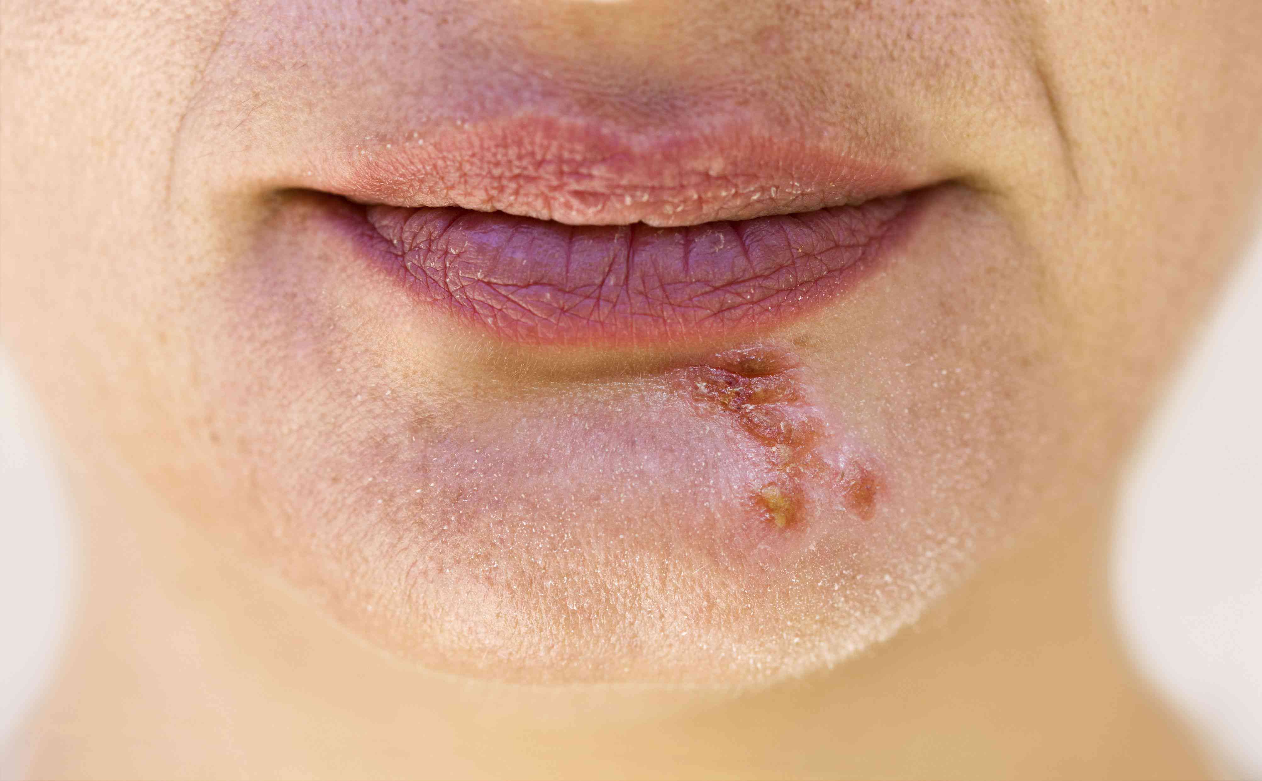 How Long Do Oral STDs Last in the Throat? What Science and Survivors Say