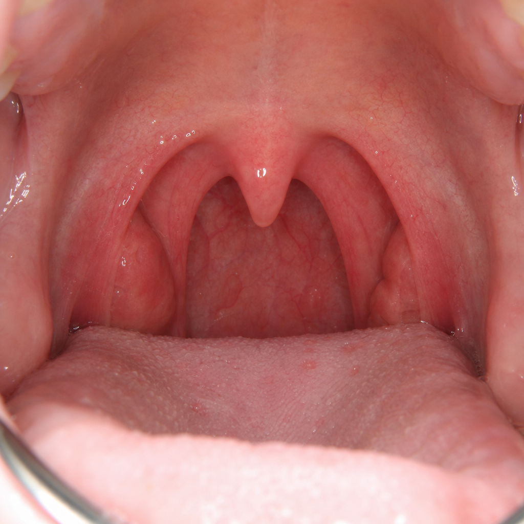 Sore Throat After Oral Sex? Could Be Gonorrhea