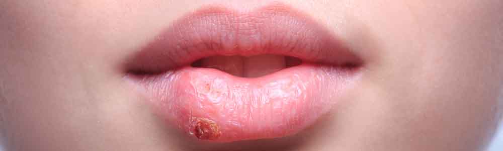 Herpes: Among the Most Prevalent STDs