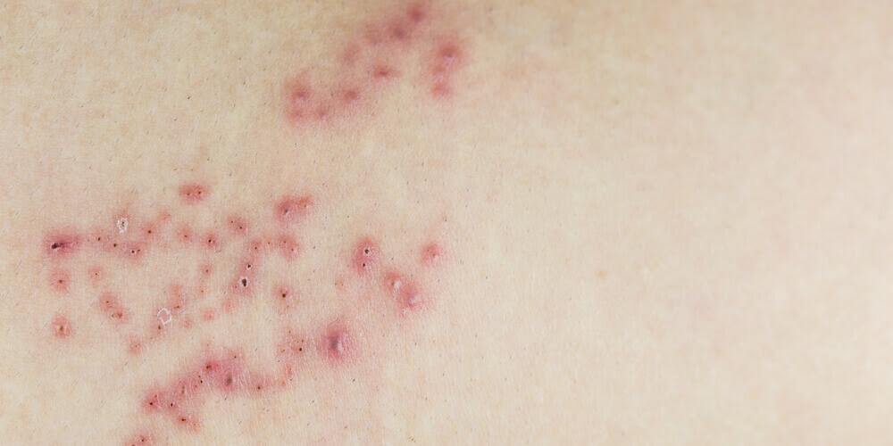Herpes? Nope. 7 Conditions That Just Look Like It