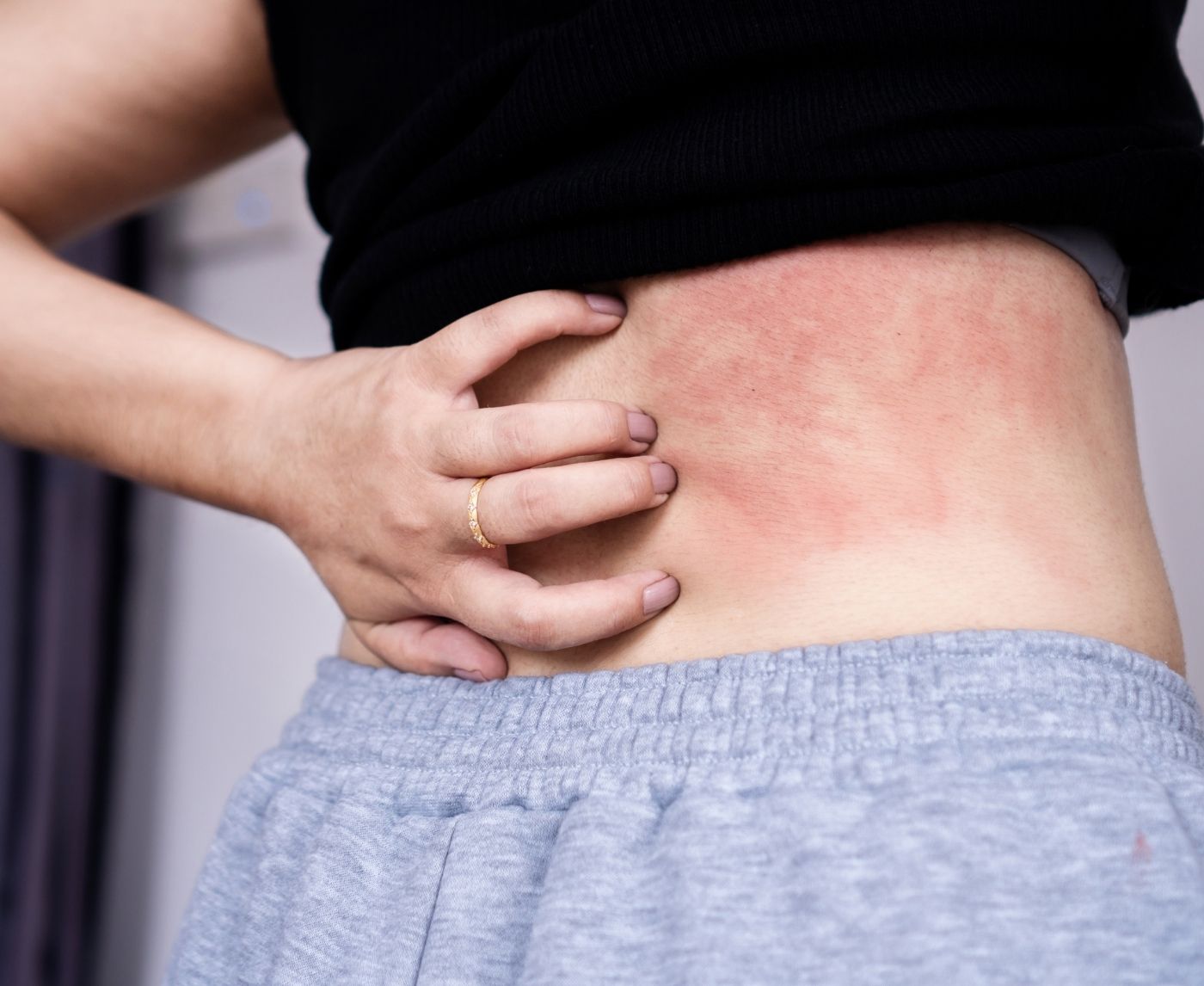 HIV or Syphilis? How to Tell If That Rash Means Something Serious