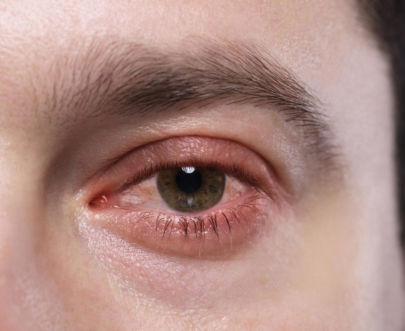 Woke Up With Red Eyes? It Could Be an STD