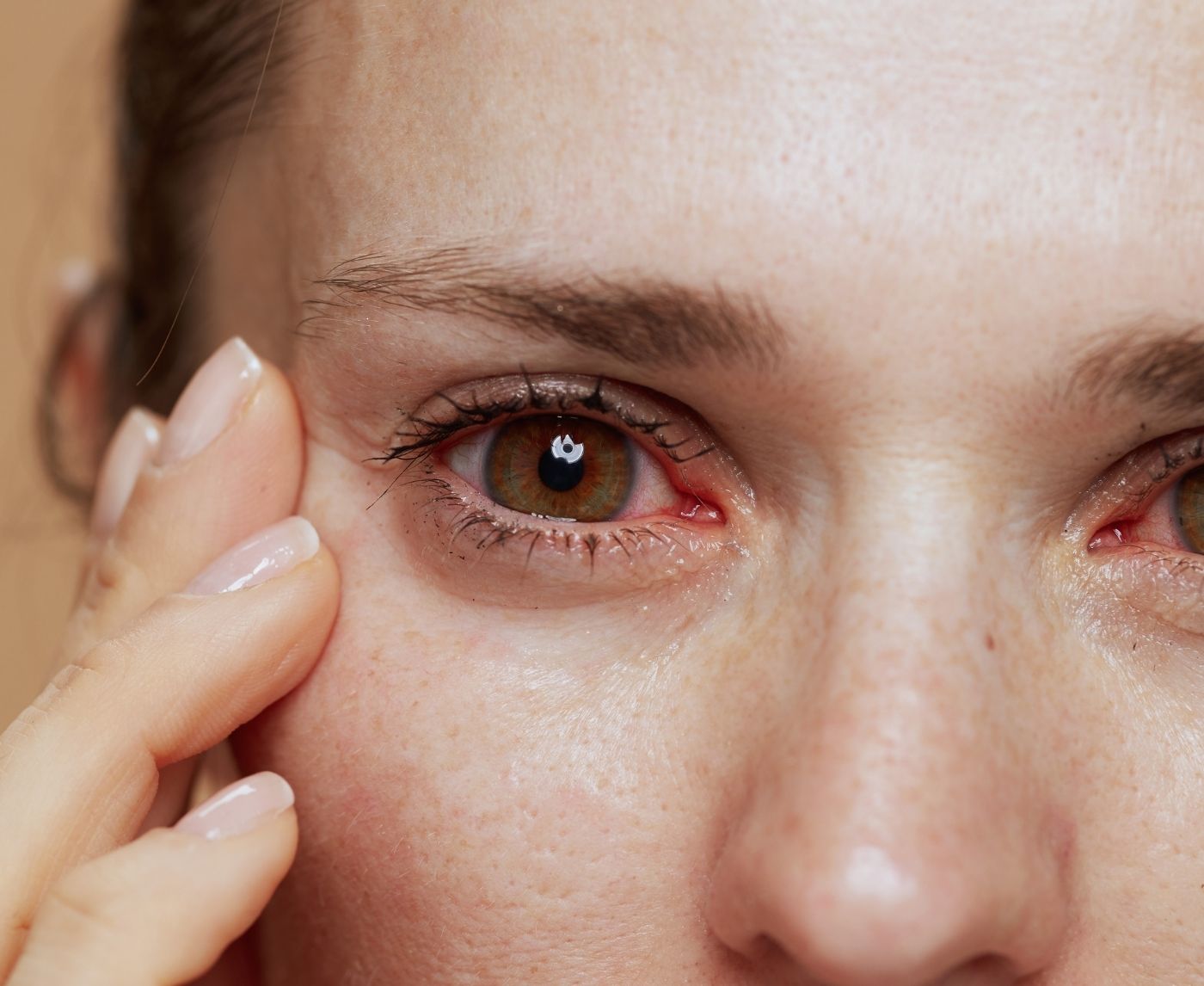 Eye Infection After a Hookup? It Might Not Be Just Pink Eye