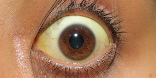 What is hepatitis C?