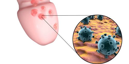 I Have Genital Sores Following Unprotected Sex