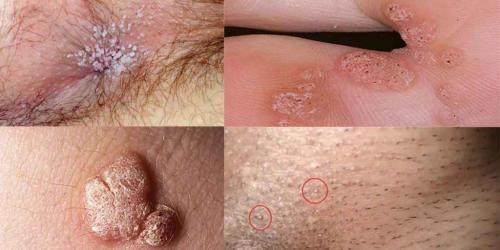 Genital Warts: A Common STD that Resembles Cauliflower