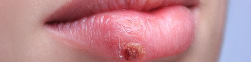 Herpes: Explanation of Causes and Transmission