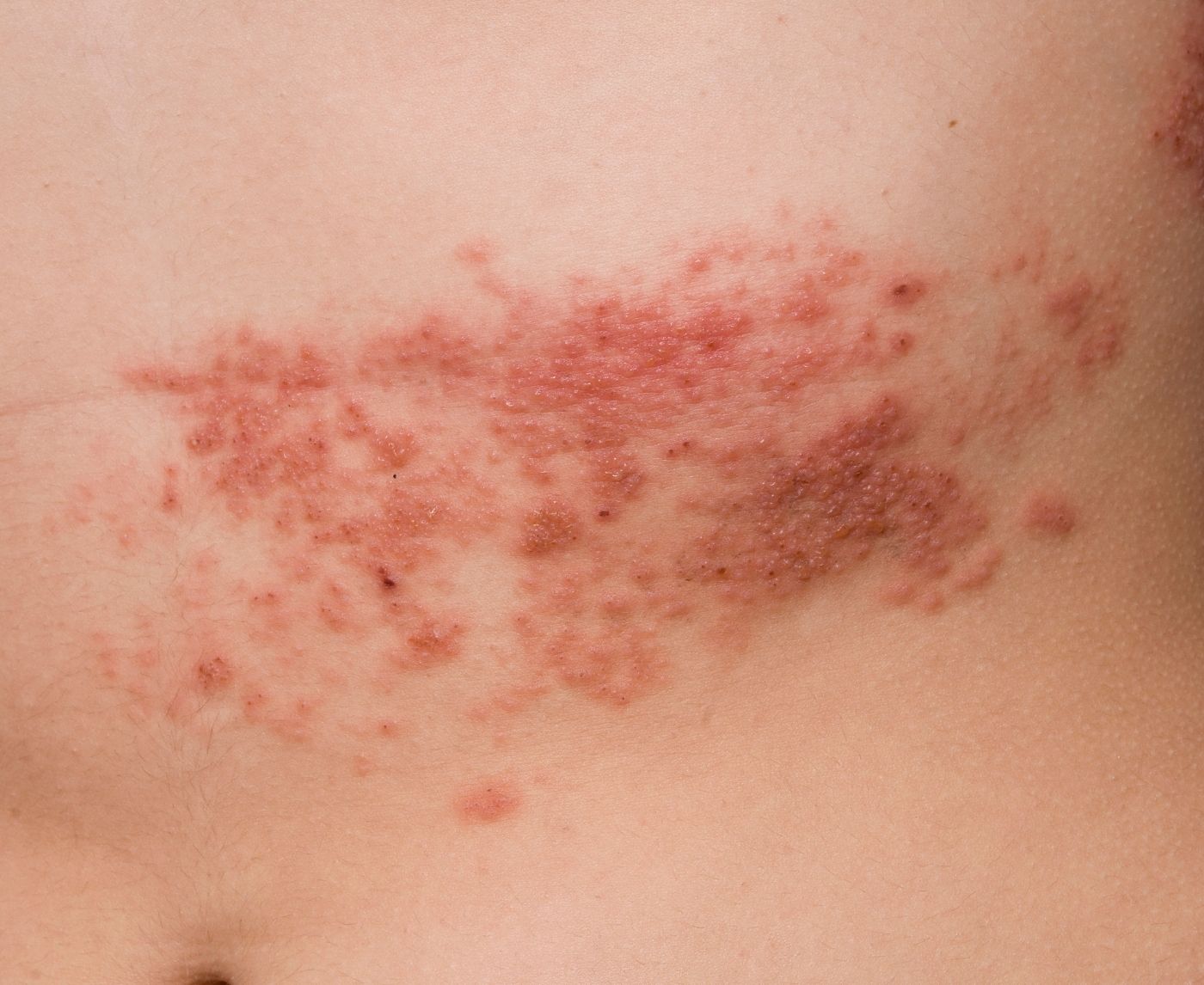 Bumps, Blisters, or Ulcers? Genital Sores and the STDs Behind Them