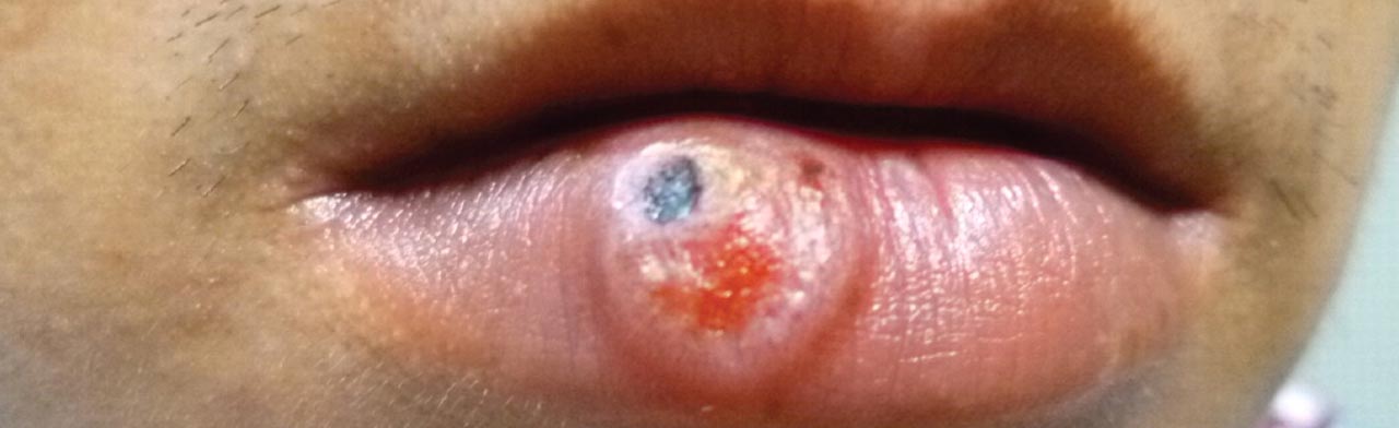 Does Syphilis affect the mouth also?