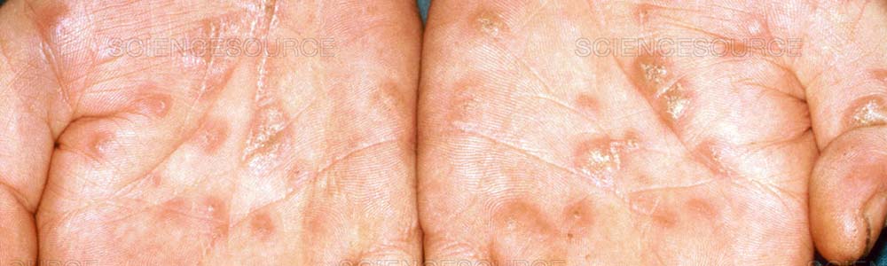 Could That Uncomfortable Sore Be a Syphilis Chancre?