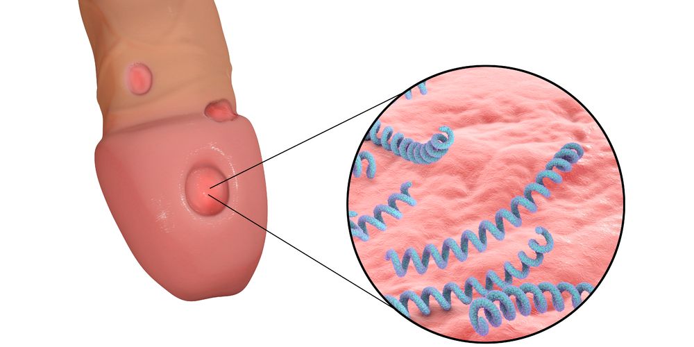 What Is Syphilis? Stages, Symptoms, Testing, and Treatment