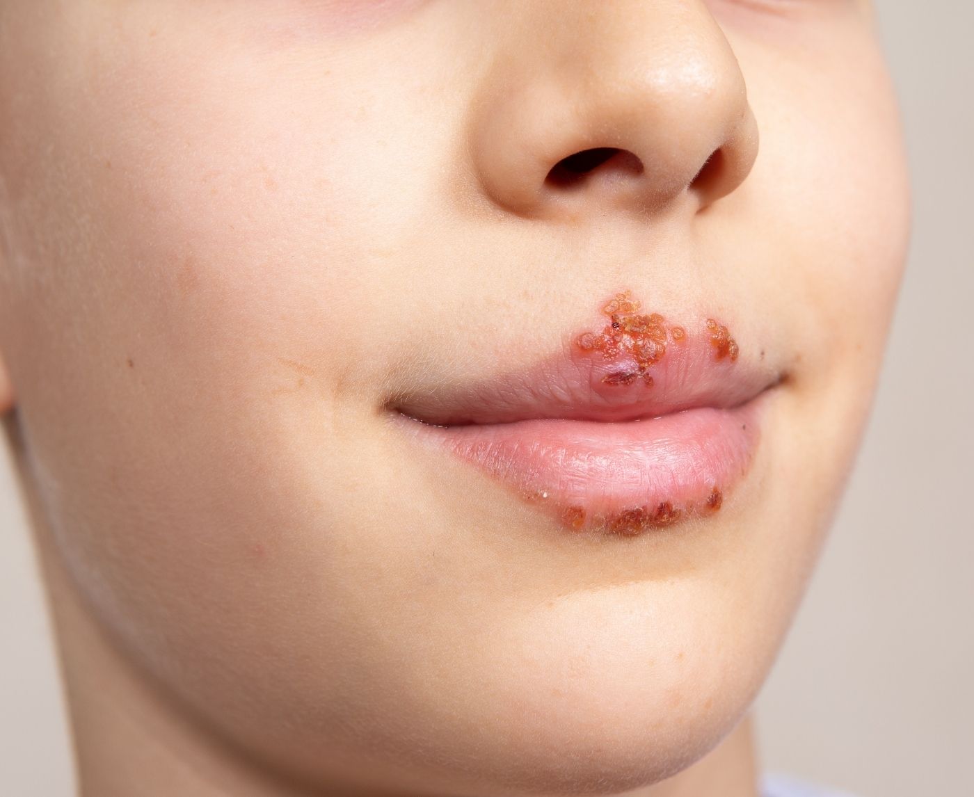 The Syphilis Surge Nobody’s Talking About (But Everyone Should Be)