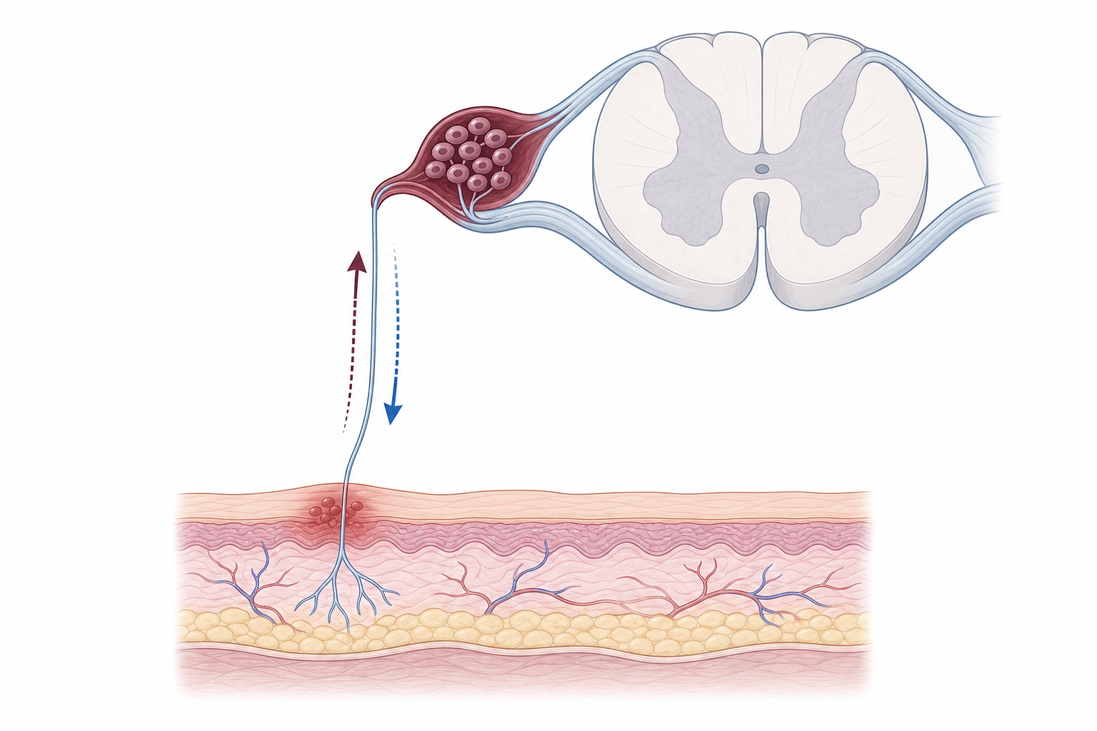 Schematic diagram showing how herpes simplex virus travels along a sensory nerve from a skin infection site to the dorsal root ganglion near the spine, where it stays dormant, with a return pathway indicating reactivation.