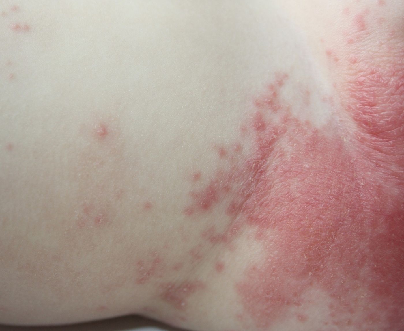 The Rare Flesh-eating STD Donovanosis