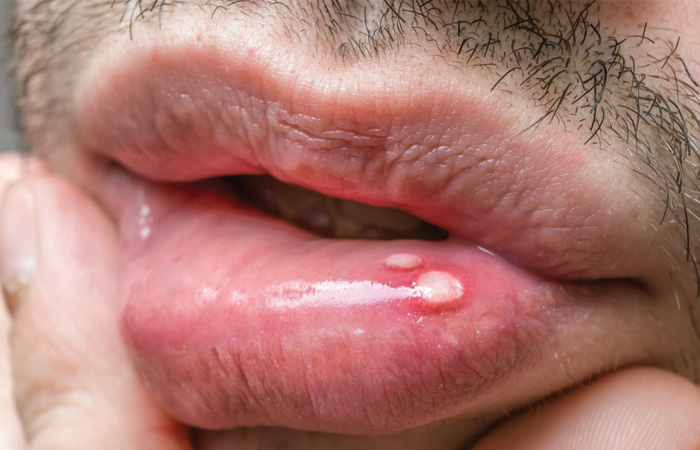 Oral Herpes