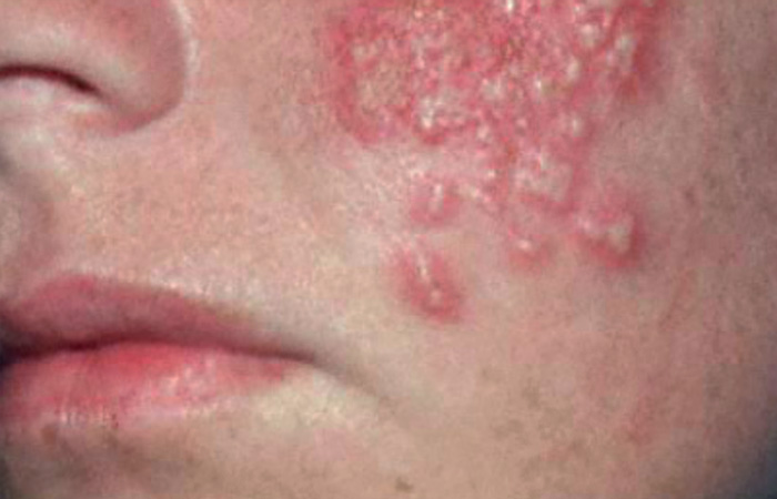 Herpes in othe places