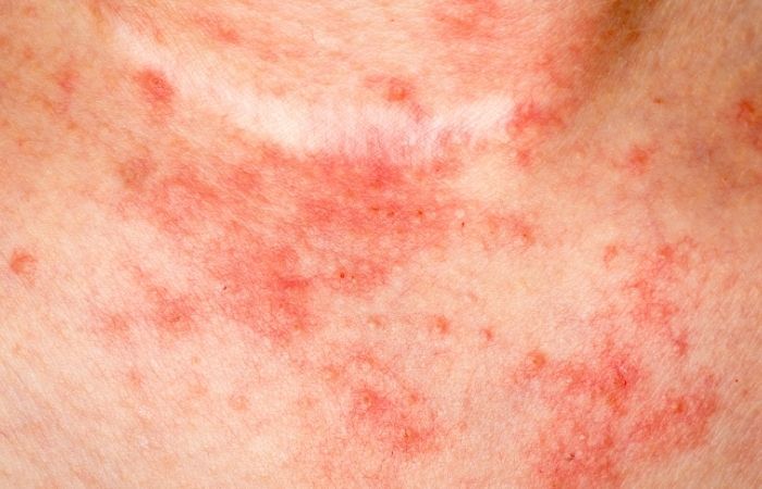 Chlamydia In Men Rash Chlamydia In Men Rash